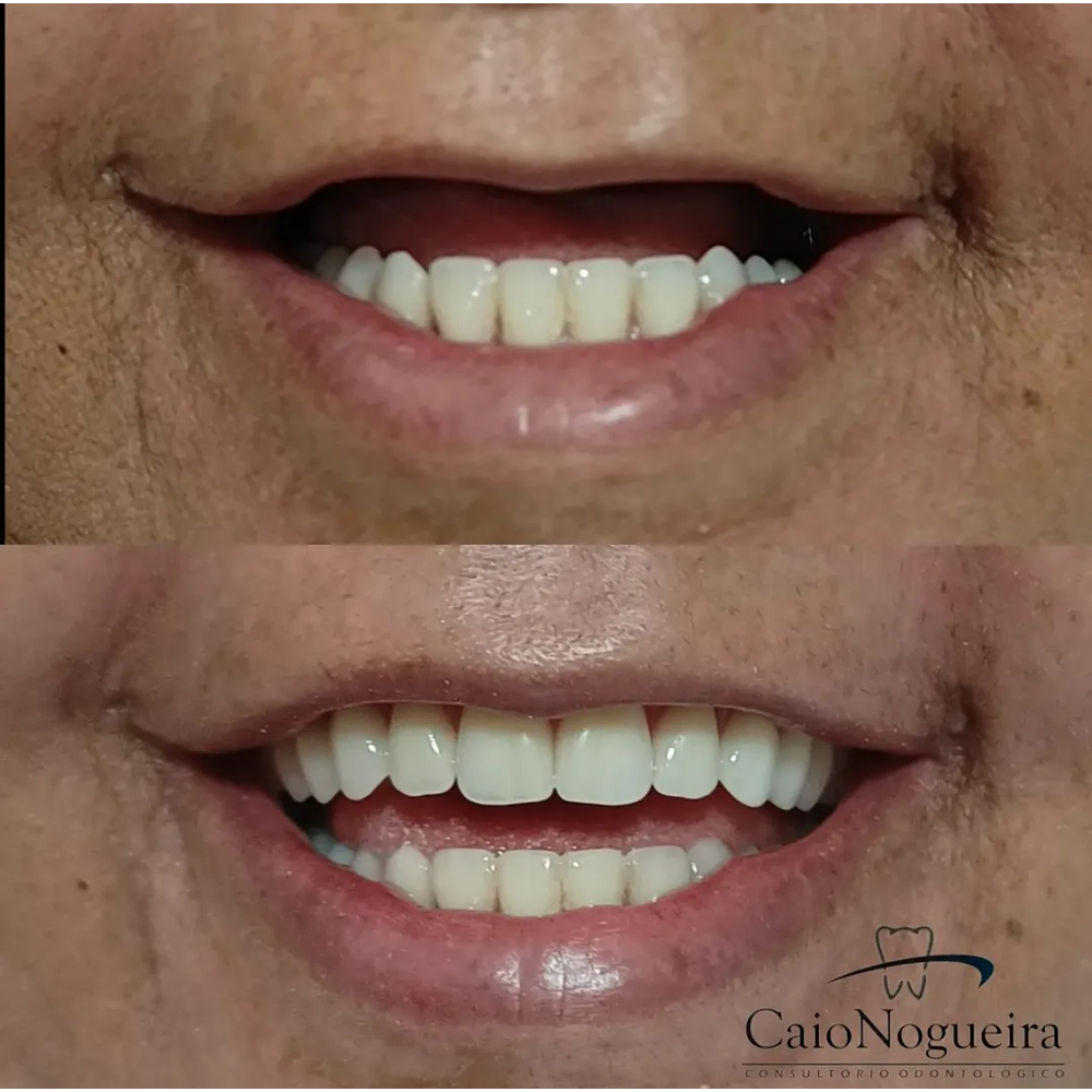 Comparação clínica de sorriso antes e depois do tratamento, apresentada pelo Dr. Caio Nogueira