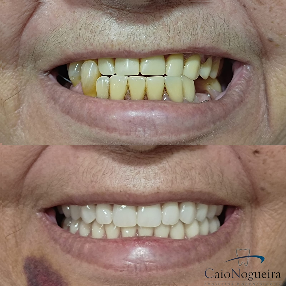 Comparação clínica de sorriso antes e depois do tratamento, apresentada pelo Dr. Caio Nogueira