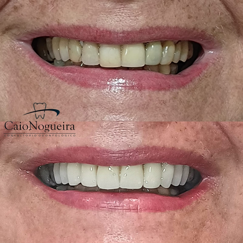 Comparação clínica de sorriso antes e depois do tratamento, apresentada pelo Dr. Caio Nogueira
